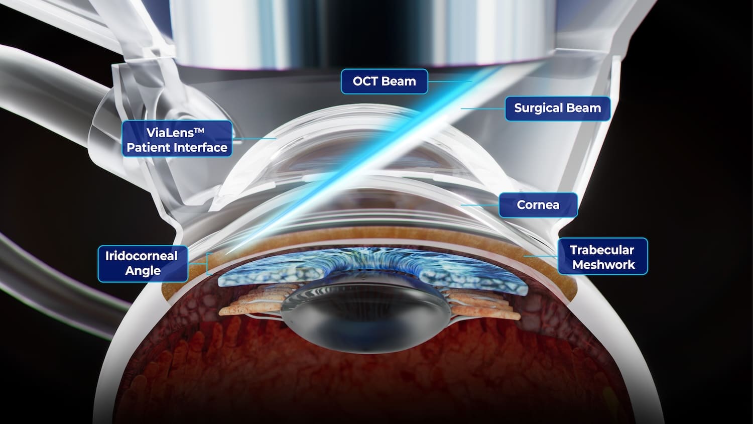 Specialized optical delivery system