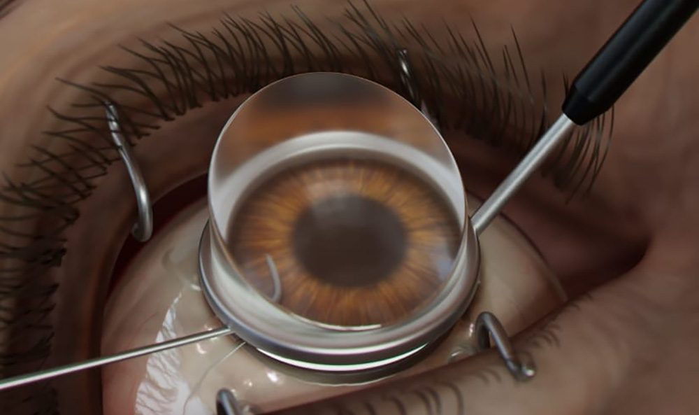Gonio Lens Procedure